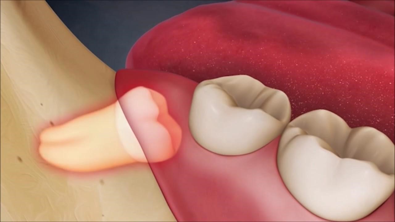 Răng khôn thường sẽ mọc ở giai đoạn độ tuổi trưởng thành là chủ yếu