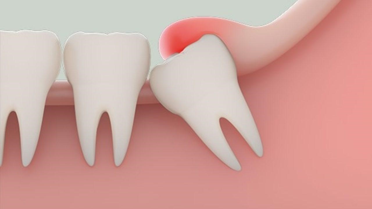 Răng khôn khi mọc gây ra nhiều triệu chứng sưng nướu và đau nhức đi kèm