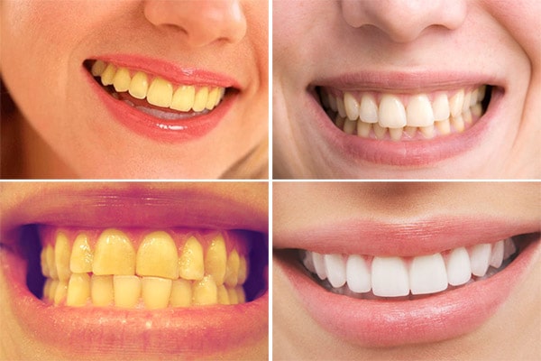 Hình ảnh trước và sau khi tẩy trắng răng