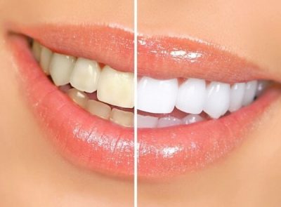 Tẩy trắng răng ở đâu tốt nhất tại TPHCM?
