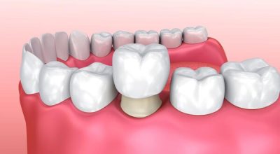 Bọc răng sứ có phải lấy tủy? | Hướng dẫn chi tiết và thông tin cần biết