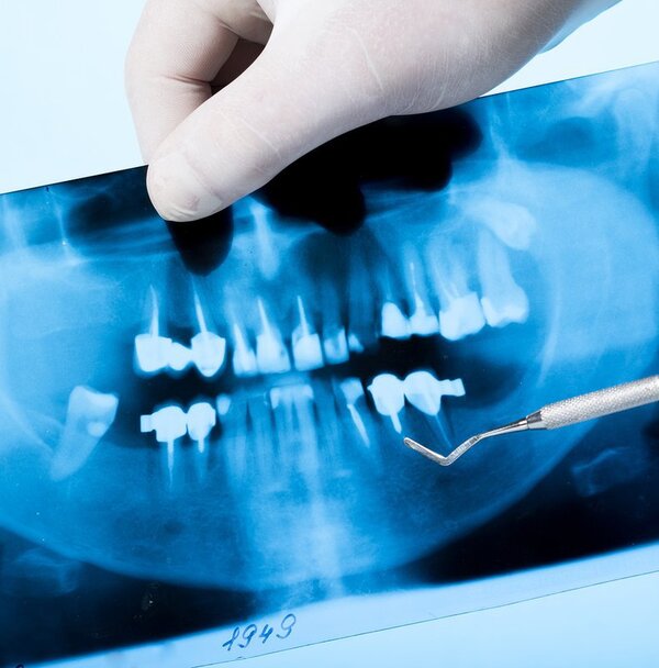 Chụp x-quang răng
