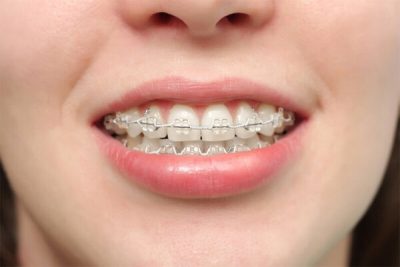 22 tuổi có thể niềng răng được không? Tìm hiểu về niềng răng ở tuổi 22