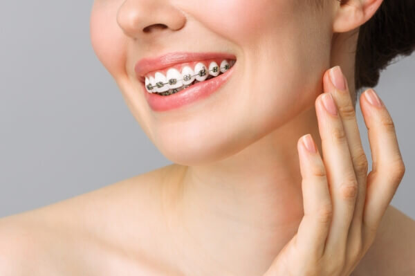 Thời gian niềng răng phụ thuộc vào tình trạng răng ban đầu của bạn.