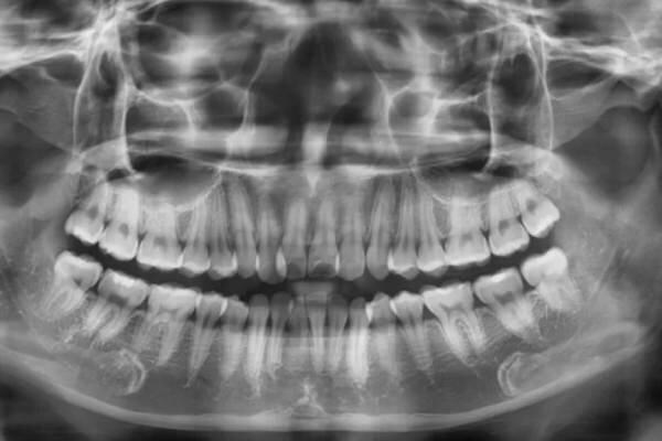 Chụp X quang nha khoa để tìm ra nguyên nhân gây nhức răng.