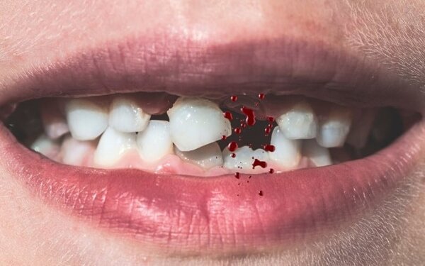Mơ gãy răng chảy máu đến từ tâm lý cá nhân.