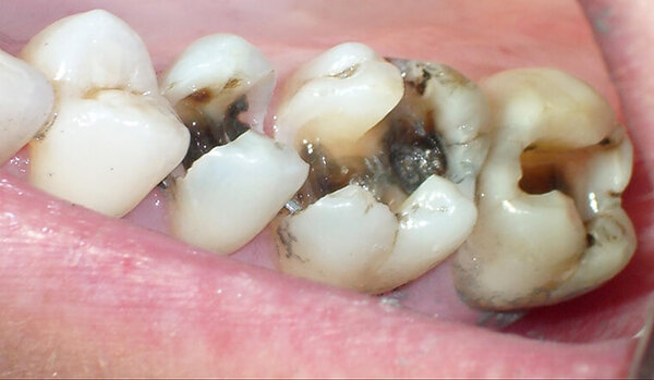 Độ sâu lỗ răng có thể ảnh hưởng đến quá trình trám răng sâu.
