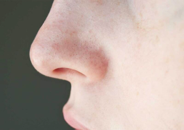 Bí tắc lỗ chân lông Bí tắc lỗ chân lông