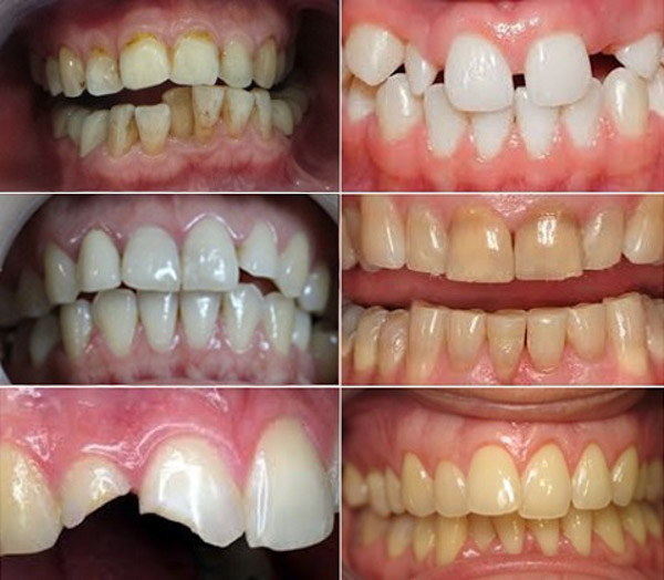 Trường hợp nào nên bọc răng sứ? Trường hợp nào nên bọc răng sứ?