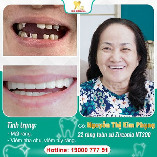 Độ tuổi nào nên bọc răng sứ? Độ tuổi nào nên bọc răng sứ?