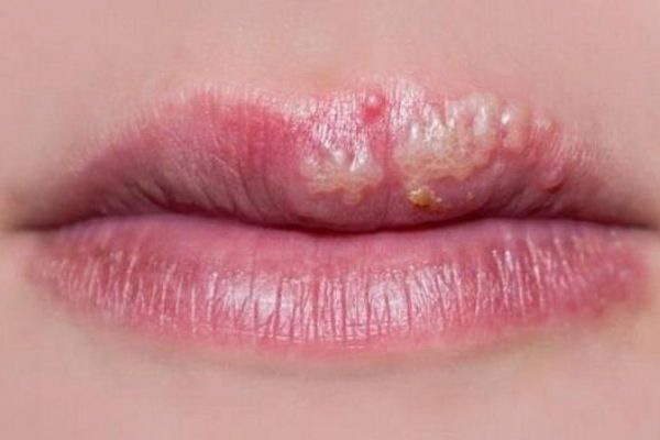 Gây ngứa, đau và dị ứng ở môi cũng như vùng da quanh miệng khi sử dụng son hết hạn