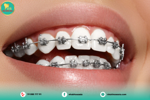 Mắc cài kim loại Mắc cài kim loại