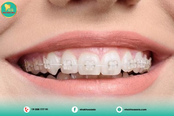 Mắc cài sứ Mắc cài sứ