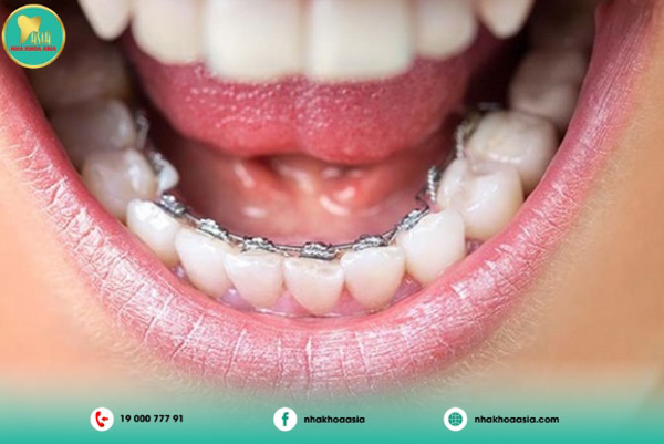 Mắc cài mặt trong Mắc cài mặt trong