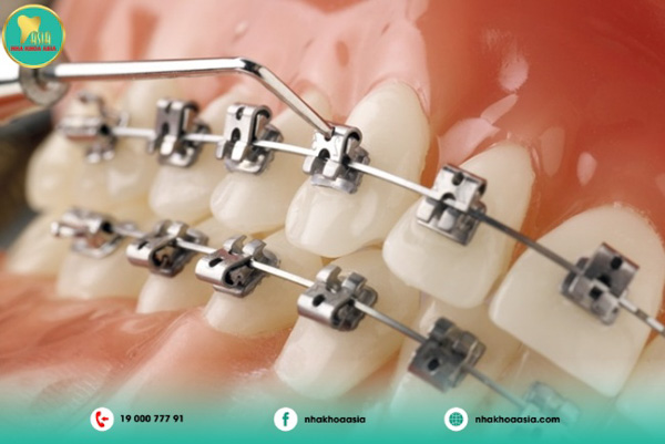 Mắc cài tự khoá Mắc cài tự khoá