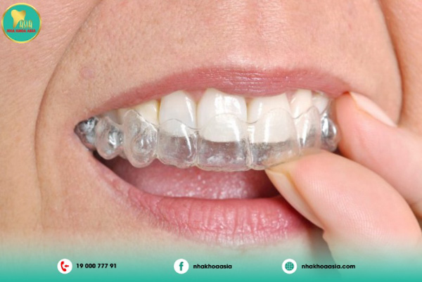 Niềng răng không mắc cài (Niềng răng Implant) Niềng răng không mắc cài (Niềng răng Implant)