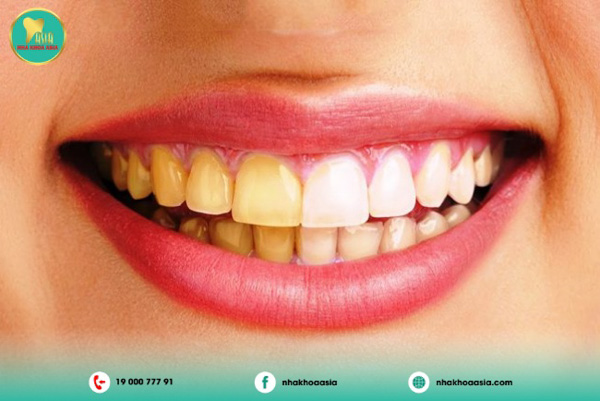 Quá trình tẩy trắng răng có gây đau đớn không?