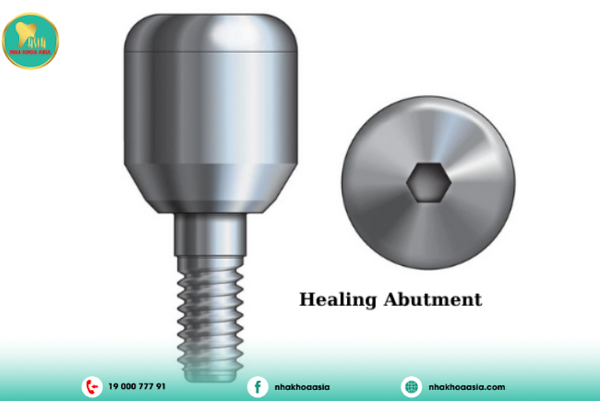 Gắn phần Healing để hướng dẫn mô nướu Gắn phần Healing để hướng dẫn mô nướu