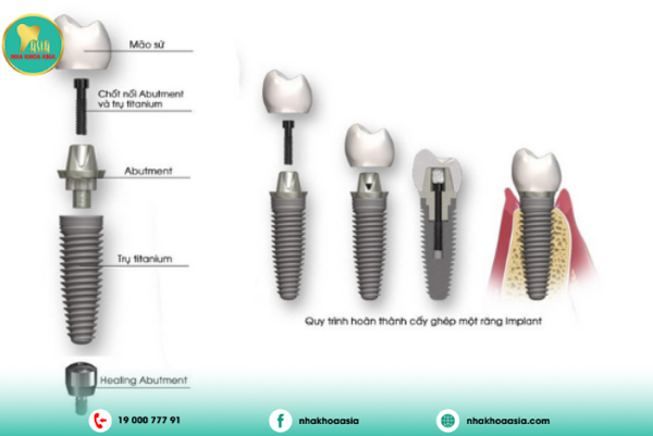 Lắp Abutment và Mão răng sứ Lắp Abutment và Mão răng sứ
